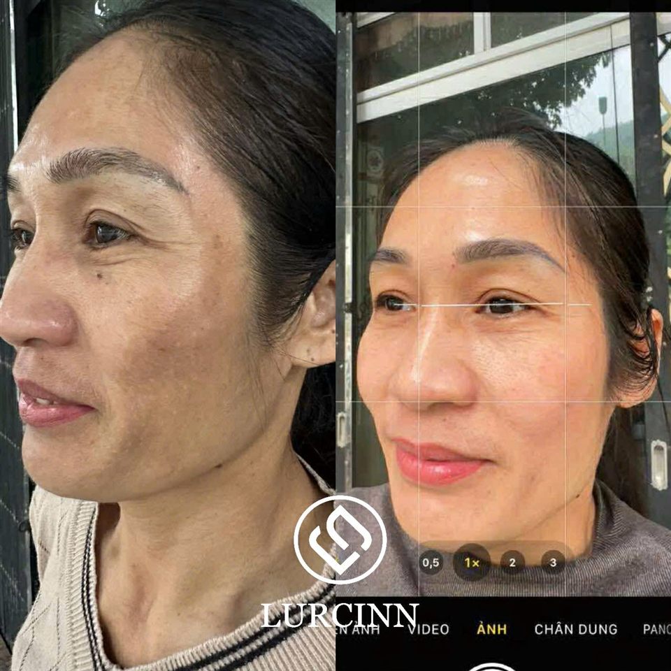Ảnh khách hàng chụp da trước và sau khi dùng, có logo Lurcinn