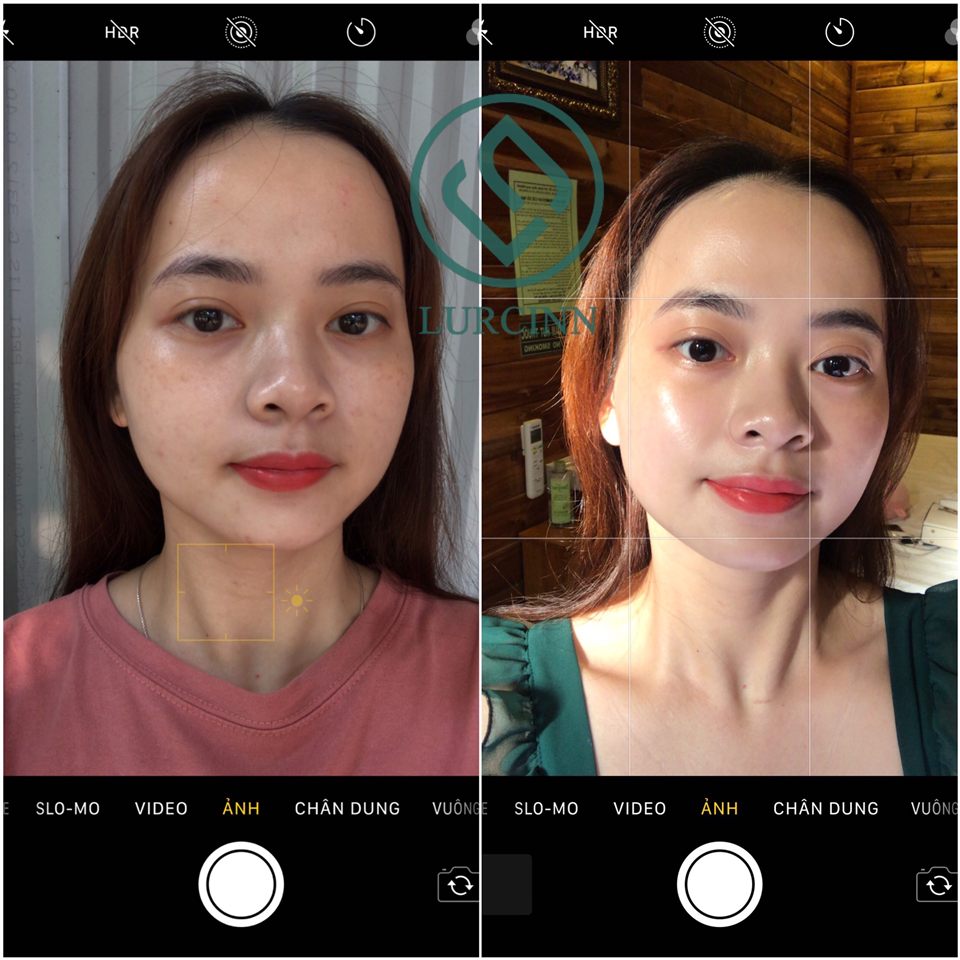 Ảnh khách hàng chụp da trước và sau khi dùng, có logo Lurcinn