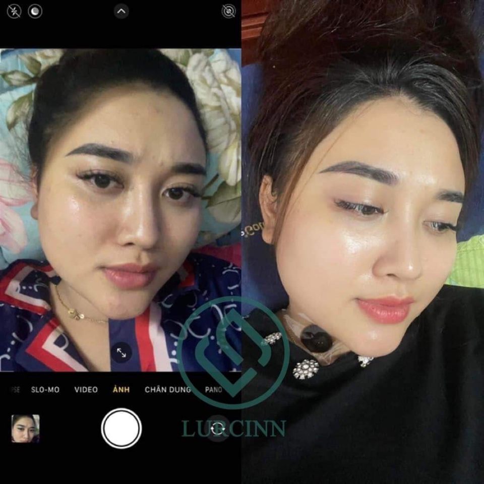 Ảnh khách hàng chụp da trước và sau khi dùng, có logo Lurcinn