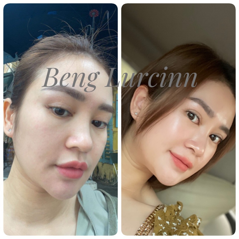 Ảnh khách hàng chụp da trước và sau khi dùng, có chữ Beng Lurcinn